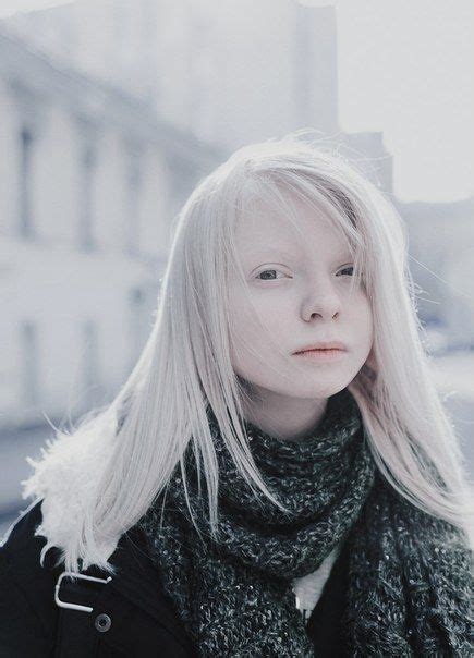 dating albino woman